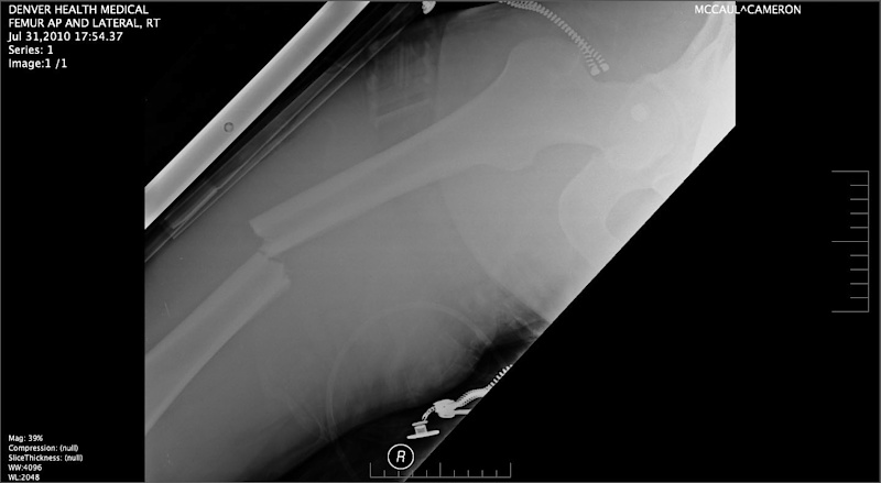 Cam's Femur after the crash