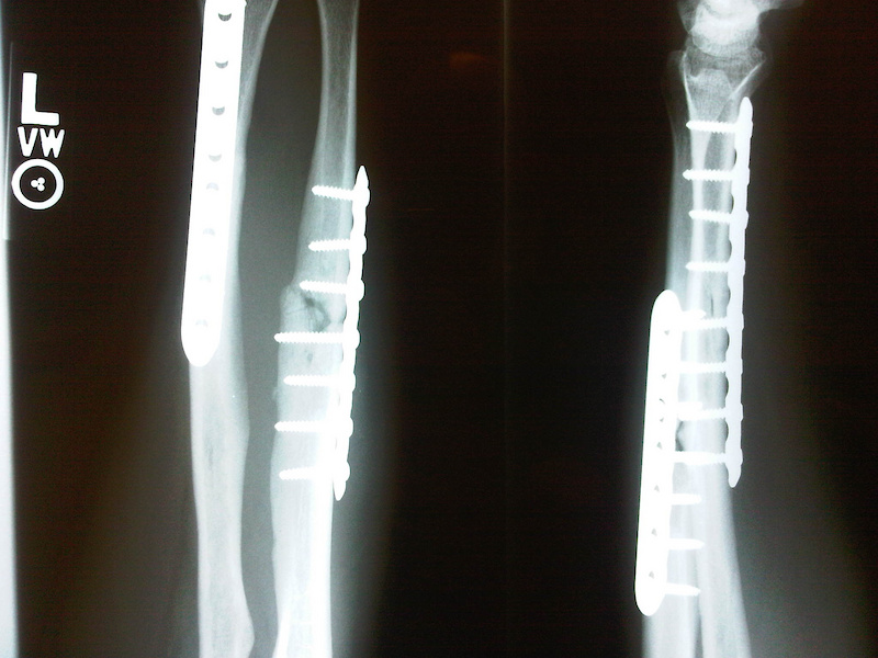 After 22 weeks the Ulna is still not completely healed. Looking at six more months bfore the bone has completely fused.