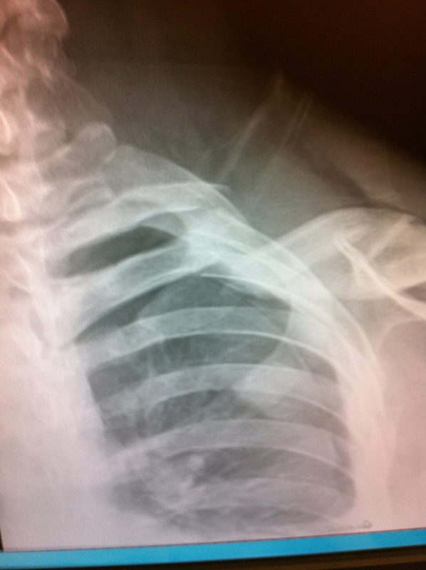 Sleeping with a broken collarbone and 2 broken ribs (on the same side)